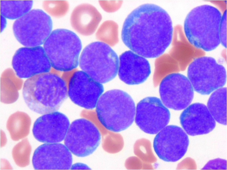 Peripheral blood smear (Wright stain) showing marked leukocytosis of malignant lymphoid cells